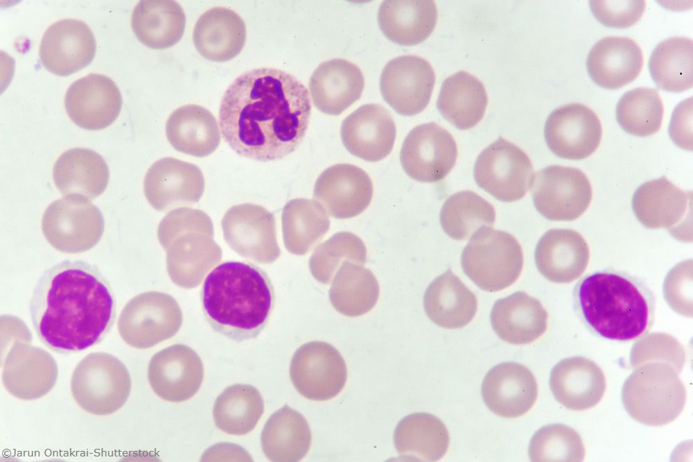 chronic lymphocytic leukemia