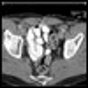 A Man With Changes in the Urinary Bladder: Benign Metaplasia or Adenocarcinoma?