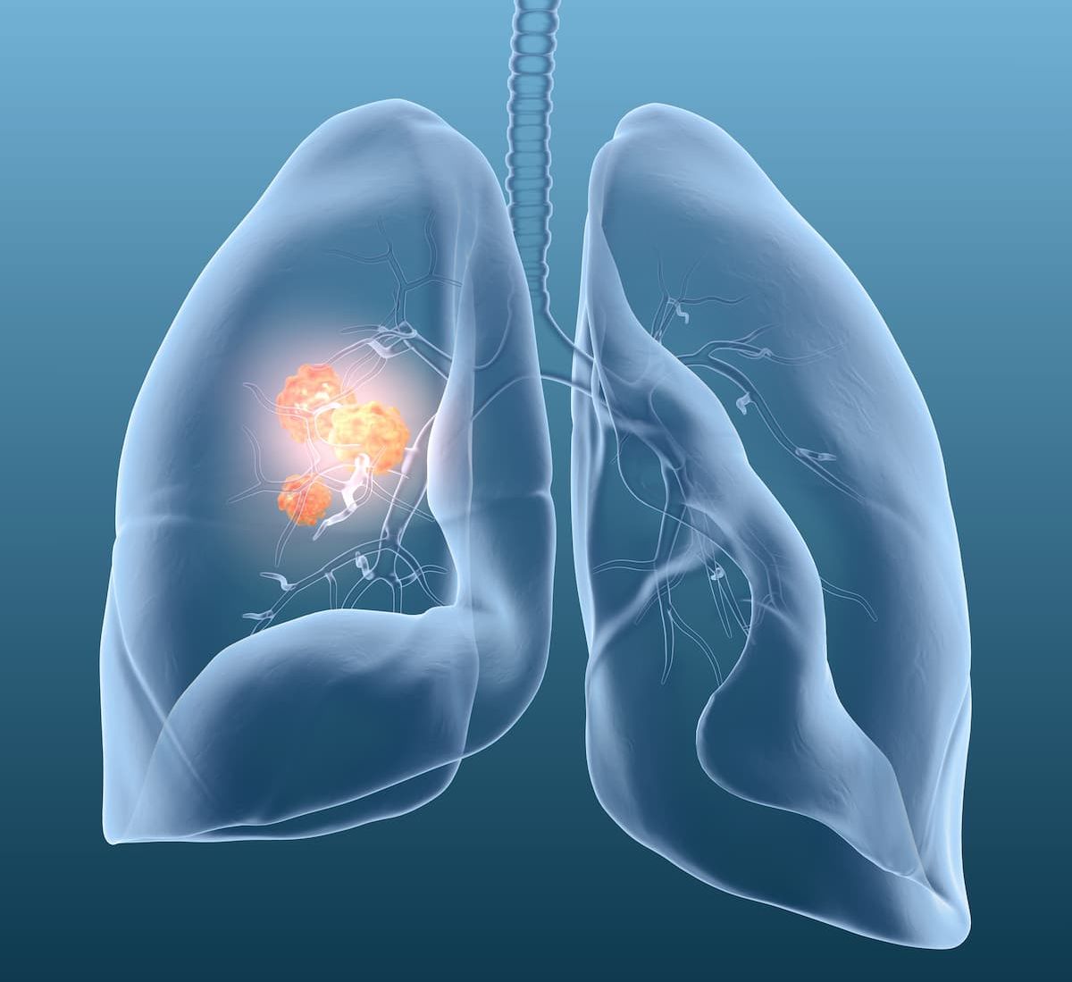 Patients With ALK+ NSCLC Not Suitable for Crizotinib Benefit from ...