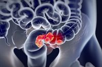 Treatment with zanzalintinib plus atezolizumab led to improvements in OS and PFS vs regorafenib alone in patients with metastatic colorectal cancer.