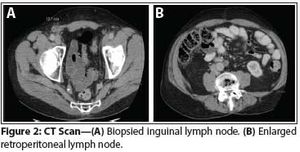 Metastatic Relapse After Initial Clinical Stage I Testicular Leydig Cell Tumor