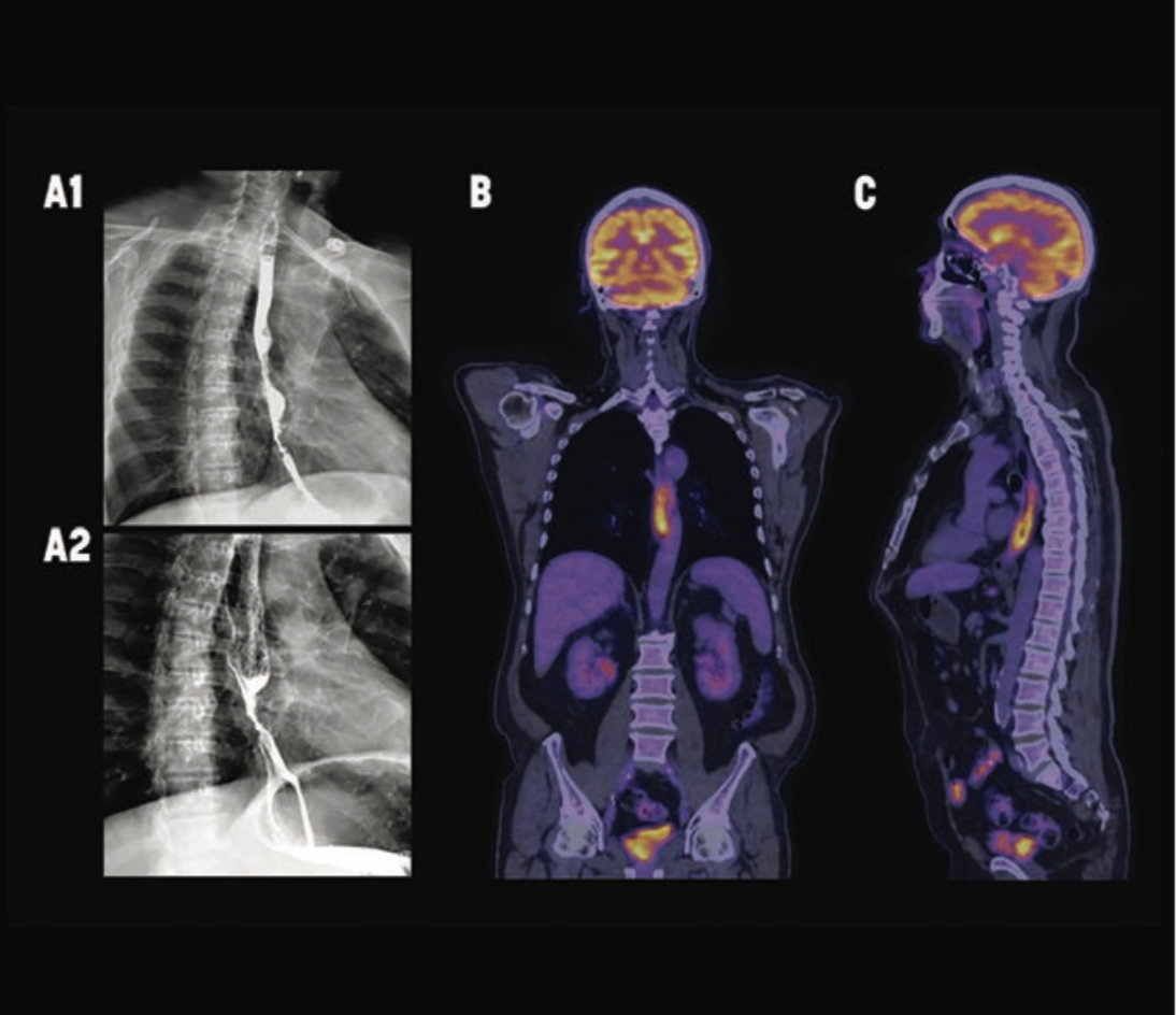 What Are the Most Common Esophageal Metastases Cancer