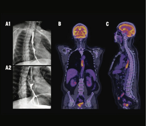 What Are the Most Common Esophageal Metastases
