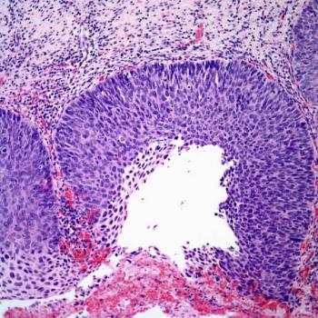 Findings from the phase 2 SKYSCRAPER-04 trial support dual targeting of TIGIT and PD-L1 in patients with PD-L1–positive cervical cancer, says Ritu Salani, MD.