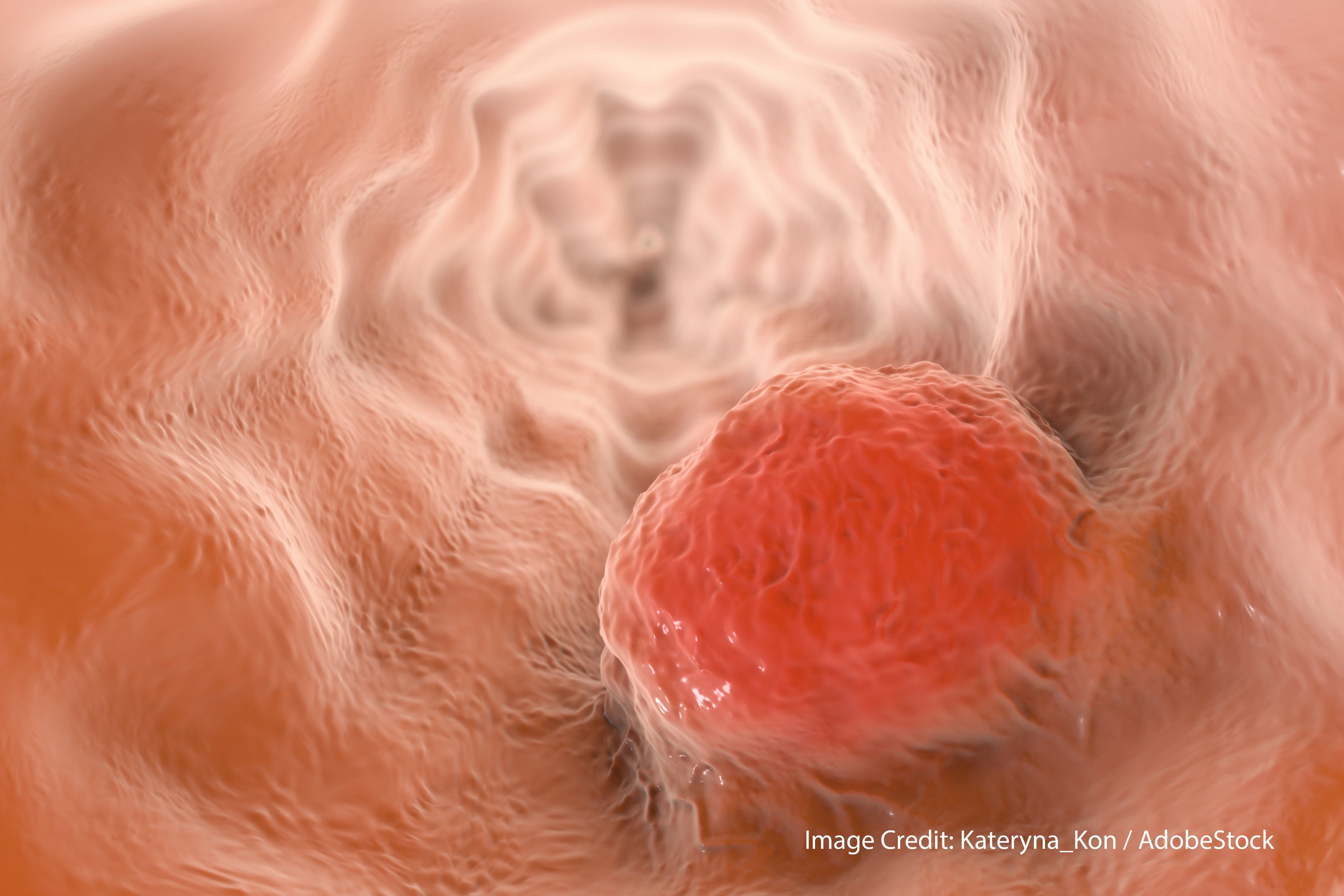 Chemotherapy Toxicity Differs by Sex in Esophageal Cancer