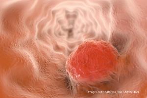 Chemotherapy Toxicity Differs by Sex in Esophageal Cancer