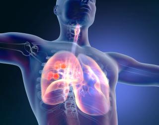 small cell lung cancer