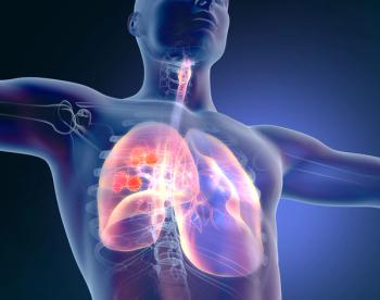 lung cancer