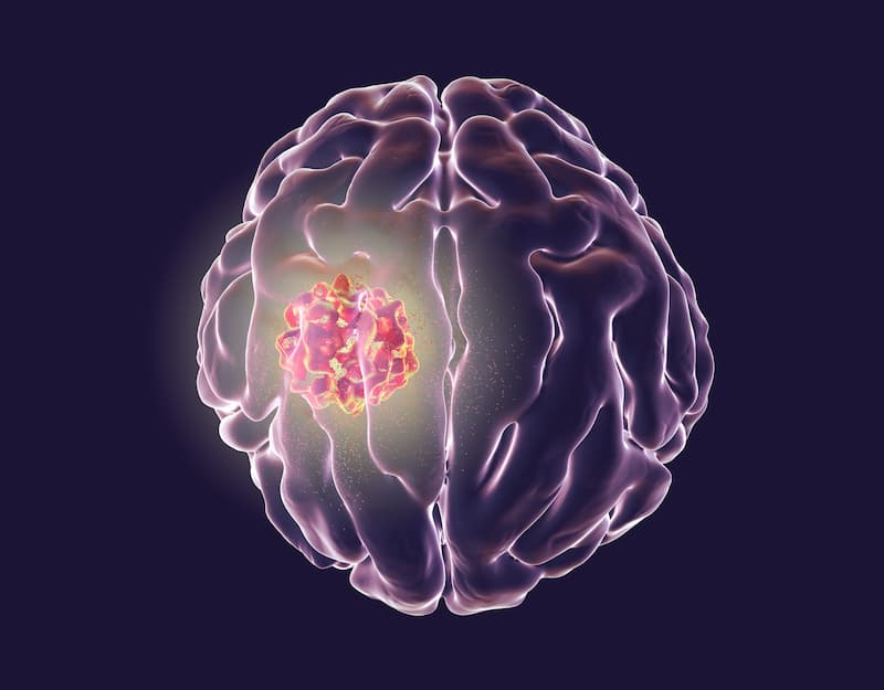 Lobaplatin Combination Regimen May Minimize Toxicity in HNSCC