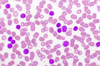 leukemia