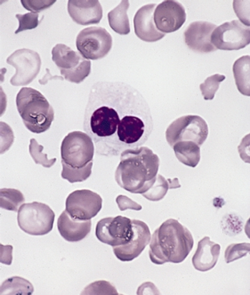 Tamibarotene is a first-in-class oral first-in-class selective retinoic acid receptor α agonist that is being evaluated in combination with azacitidine for newly diagnosed higher-risk myelodysplastic syndrome.