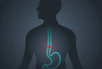 Investigators report that patients with advanced or metastatic esophageal squamous cell carcinoma had superior overall survival benefit following treatment with tislelizumab/chemotherapy vs placebo/chemotherapy.