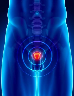Focus on Transitional Disease: A Critical Interval to Delay Progression of Prostate Cancer