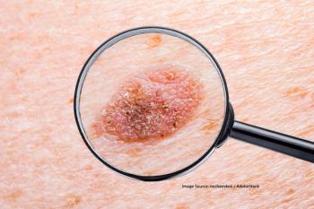 A phase 3 trial evaluating frontline IFx-2.0 with pembrolizumab in advanced/metastatic Merkel cell carcinoma is planned to start later in June 2025.