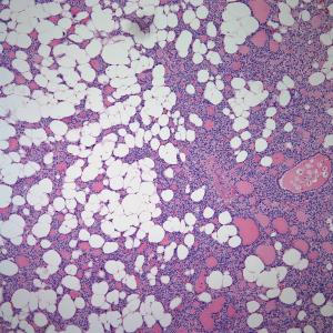 Thyroid Nodule Found in 43-Year-Old Man