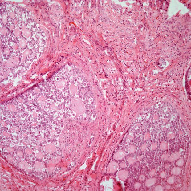 The Carolina Frailty Index Score indicates that patients with ovarian cancer classified as frail are highly more likely to die than patients classified as robust.