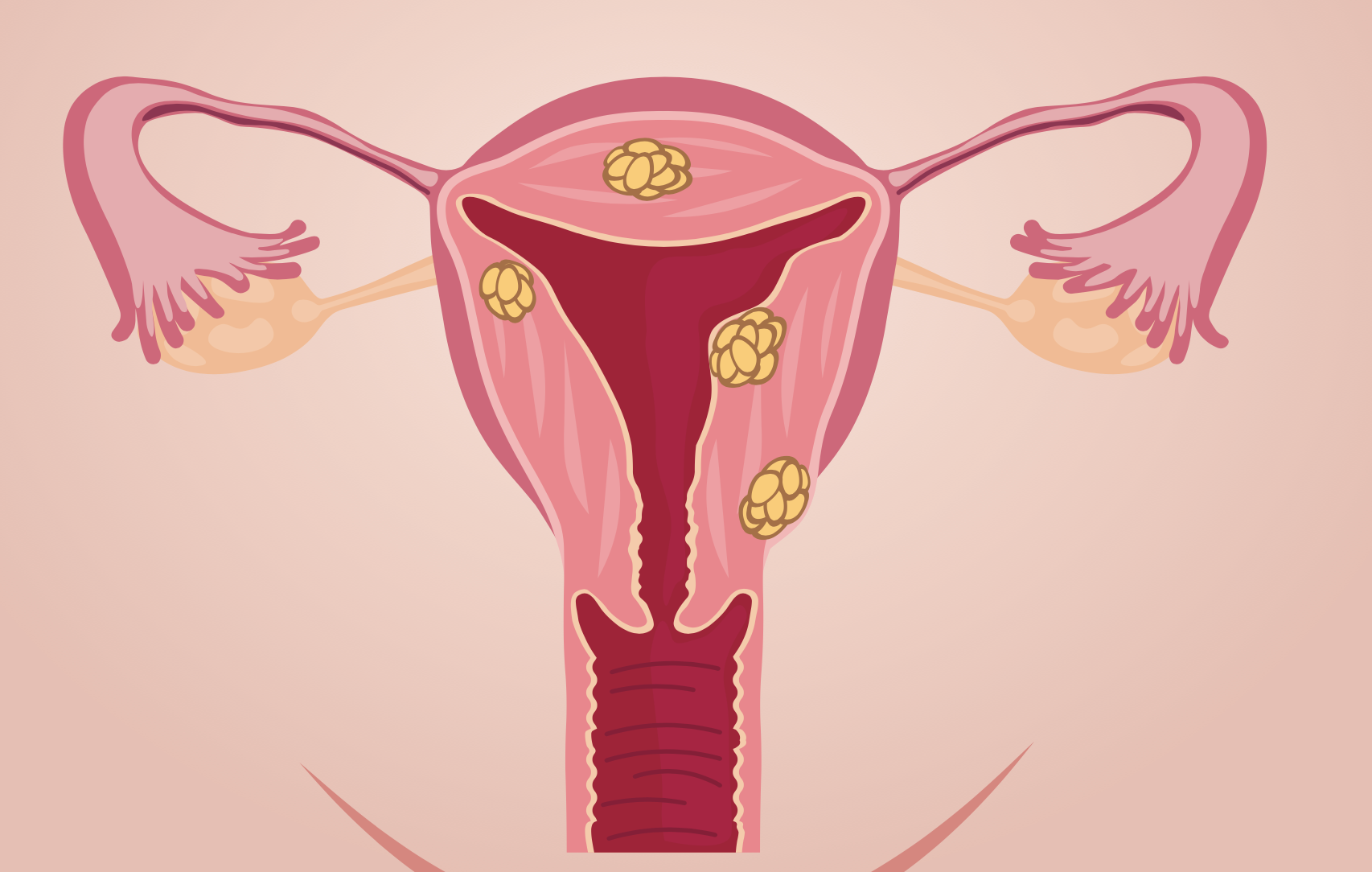 Approval Alert | <b>Pembrolizumab for Advanced MSI-H/dMMR Endometrial Cancer</b>