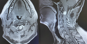 Spinal ATRT and Radiotherapy Case Report in an Adult Man