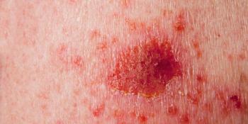 Phase 3 data may support the photodynamic therapy as a noninvasive treatment option for patients with superficial basal cell carcinoma.