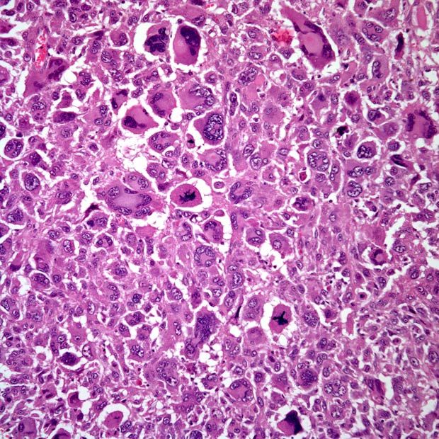 Slide Show Anaplastic Thyroid Carcinoma Cancer Network