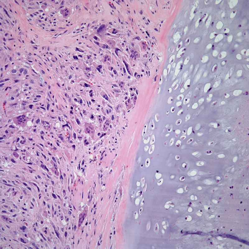 Patient Presents With Pelvic Mass Lesion