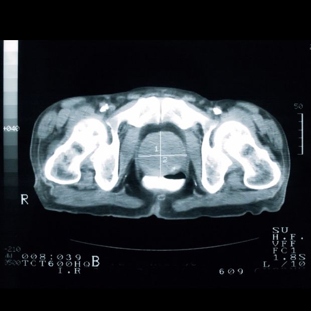 CT scan of prostate cancer