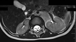 Opsoclonus-Myoclonus–Associated Neuroblastoma With Bone Marrow Metastases: What Would Be the Best Treatment Option?