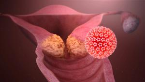 Expert Commentary on the Product Profile of Tisotumab Vedotin in Cervical Cancer