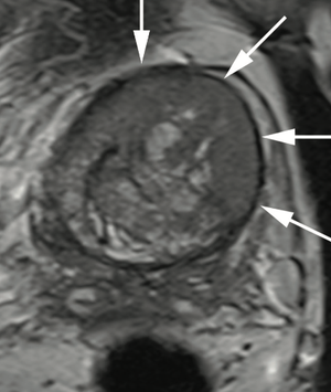 Successful Diagnosis and Treatment of Occult Prostate Cancer Despite Multiple Negative Prostate Biopsies and Negative Prostate MRIs