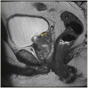 Median Lobe Urethral Embolus After Focal Ablation of Gleason 7 Prostate Cancer