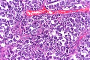 Current Frontline Treatment of Diffuse Large B-Cell Lymphoma