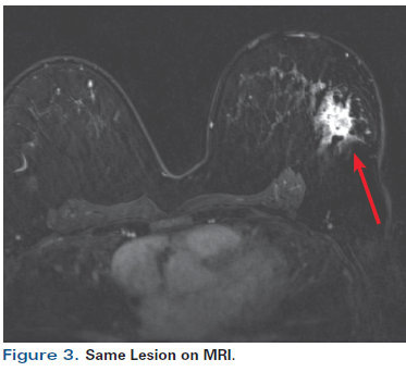 A 55 Year Old Woman With New Triple Negative Breast Mass Less Than 2 Cm On Both Mammogram And Ultrasound