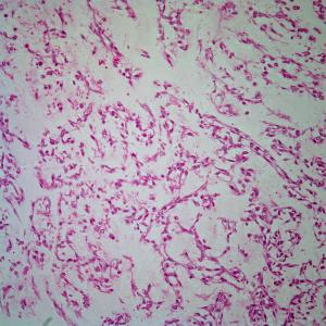 56-Year-Old Man With Subcutaneous Soft Tissue Mass in Right Leg