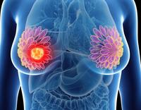 GLP-1 Receptor Agonists in Breast Cancer: 5 Key Clinical Takeaways