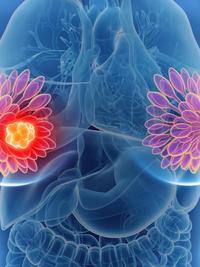 Paxalisib Combination Shows Meaningful Activity in Metastatic TNBC