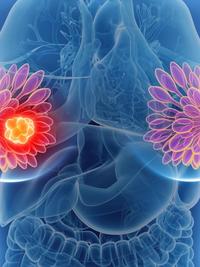 GLP-1 Receptor Agonists in Breast Cancer: 5 Key Clinical Takeaways
