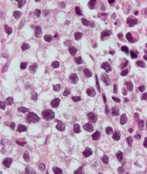 Treatment with retroperitoneal lymph node dissection for testicular seminoma with limited retroperitoneal lymphadenopathy is associated with low long-term morbidity.