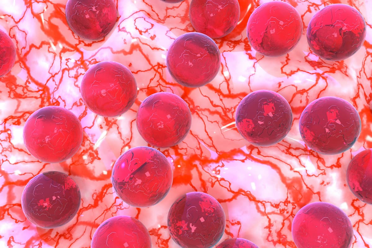 Data from AMPLIFY show a trend towards improved overall survival with acalabrutinib-based therapy among patients with chronic lymphocytic leukemia.