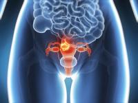 The SISTER trial was the first national randomized trial to demonstrate significantly improved outcomes for black women with endometrial cancer.