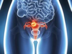 Pembrolizumab/Chemo Boosts PFS in Advanced/Recurrent Endometrial Cancer