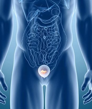 Detalimogene voraplasmid demonstrated a 71% any-time CR rate in this non-muscle invasive bladder cancer population in the phase 1/2 LEGEND trial.