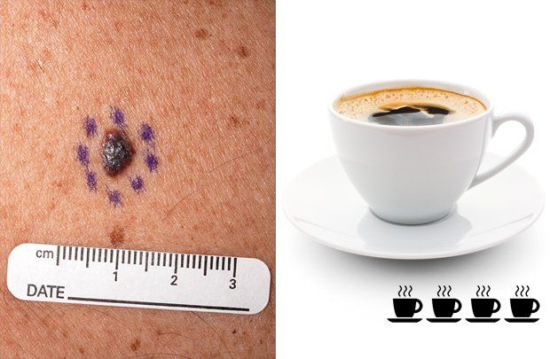 Coffee and melanoma risk