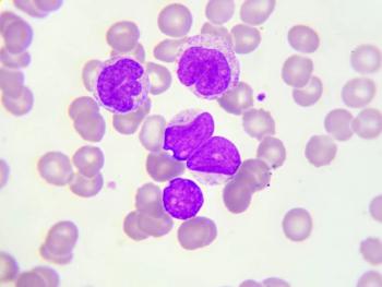 Promising Efficacy Seen With Addition of Orelabrutinib to R-CHOP in Non-GCB DLBCL