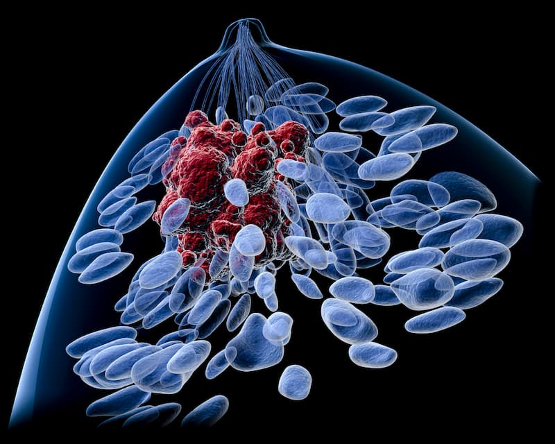 Survival Benefit Observed With Ribociclib Plus Endocrine Therapy in Advanced HR+/HER2– Breast Cancer With Visceral Metastases