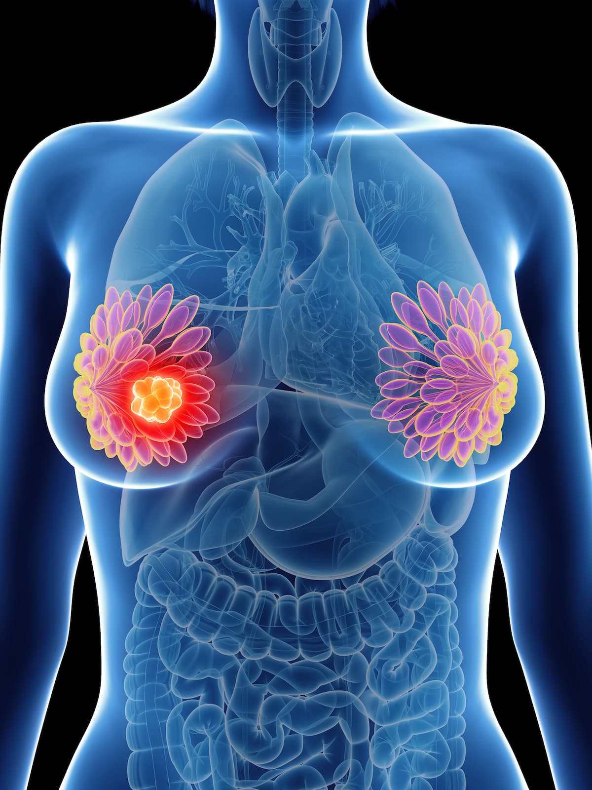 健康・医学 Breast Cancer T-DM1/Brain SRS May Increase Risk of Radionecrosis in Breast