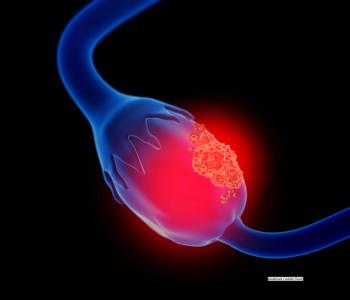 Maintenance olaparib plus bevacizumab may improve survival in patients with high-grade ovarian cancer regardless of BRCA mutation location, according to a subgroup analysis of the PAOLA-1/ENGOT-ov25 trial.