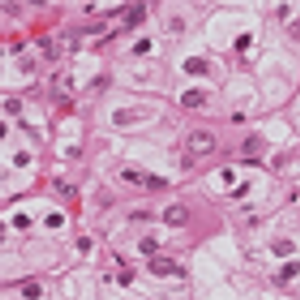 Mass Found in Left Kidney of Patient With von Hipple-Lindau Syndrome