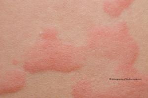 Mogamulizumab Approved for Two Rare Types of Cutaneous T-cell Lymphoma