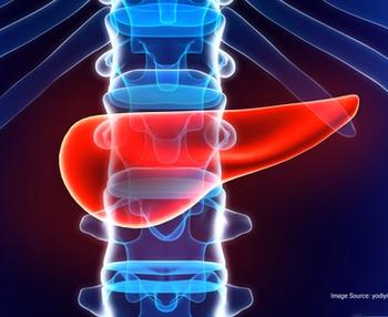 Stereotactic online adaptive magnetic resonance guided radiation therapy was well tolerated and maintained stable QOL in patients with PDAC for up to 1 year. 