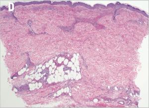 Leukocytoclastic Vasculitis Induced by Immune Checkpoint Inhibition in a Patient With Advanced Renal Cell Carcinoma